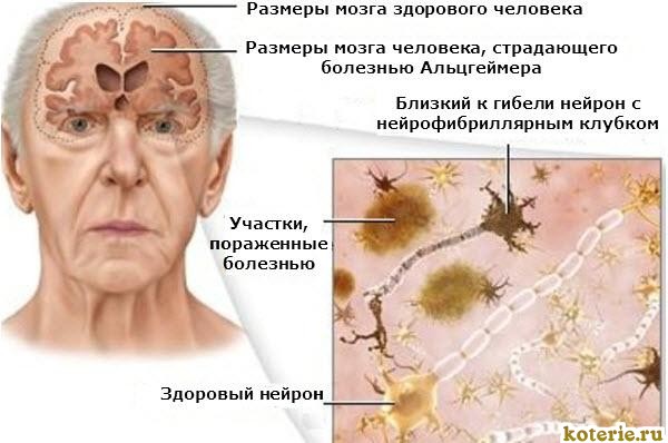 Болезнь Альцгеймера у женщин